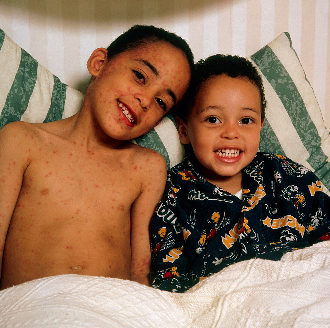 Boy with chickenpox sits in bed with brother