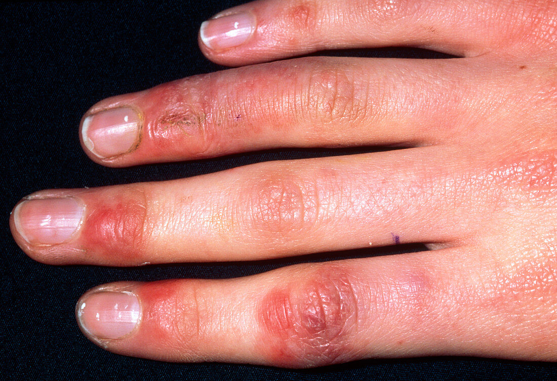 Chilblains on the fingers of a 16 year old girl