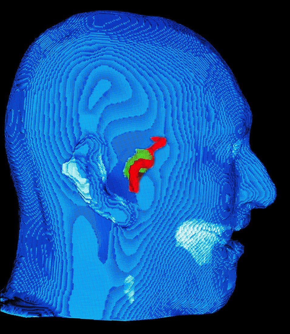 Coloured 3-D MRI scan of a brain cyst