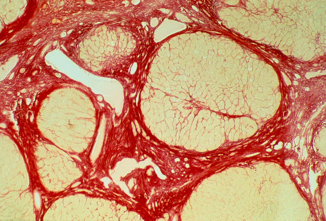LM of liver tissue showing cirrhosis
