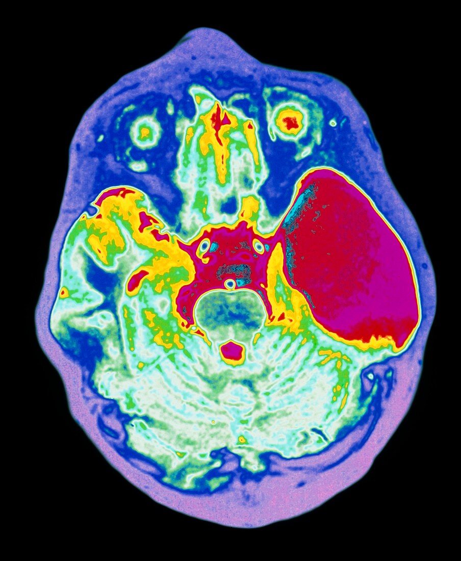 Coloured MRI brain scan showing an arachnoid cyst