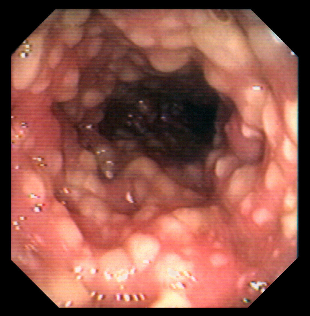 Inflamed colon