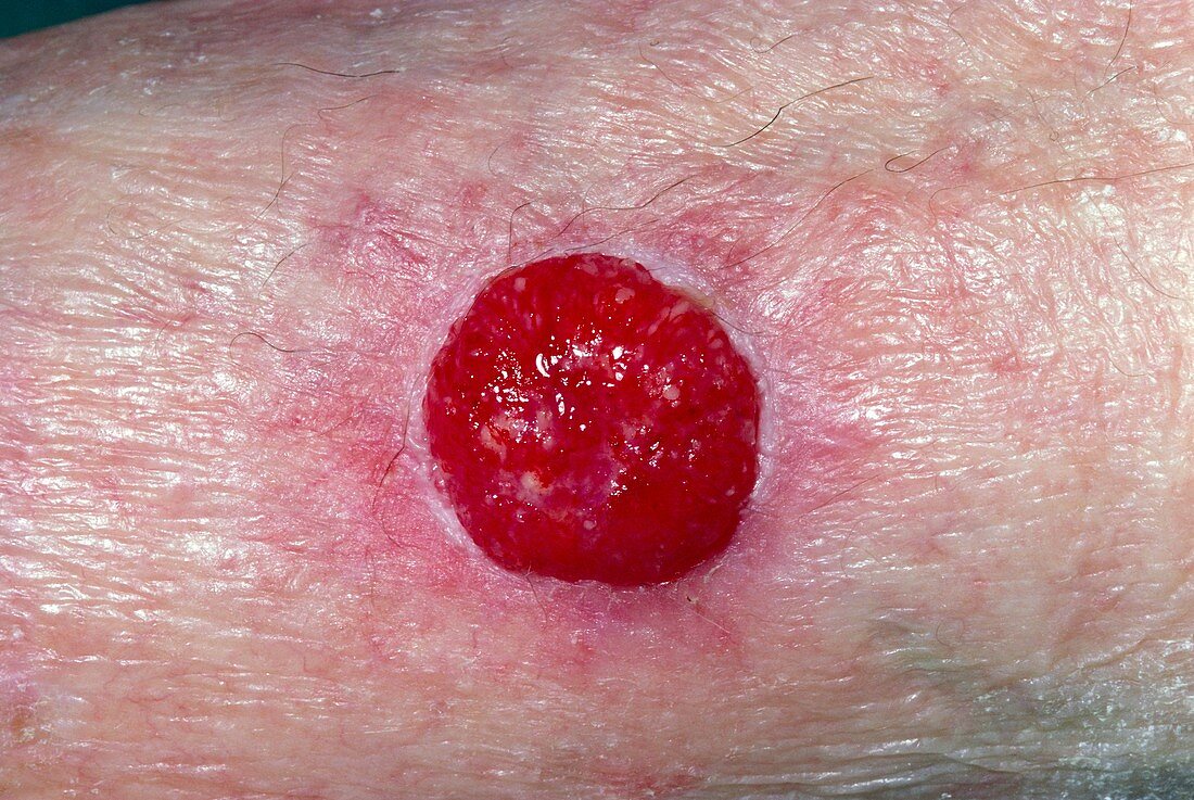 Sebaceous cell carcinoma (skin cancer) on leg