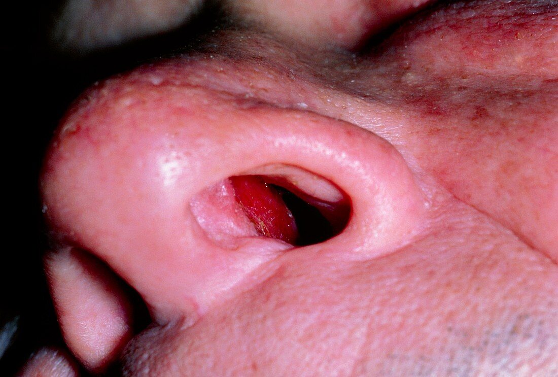 Squamous cancer of nose 6 months post radiotherapy