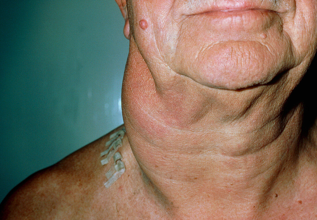 Non-Hodgkin's lymphoma: neck lymphadenopathy