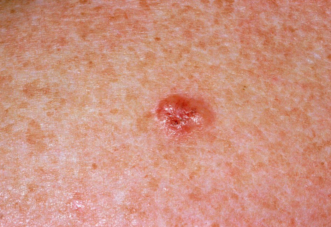 Close-up showing a basal cell carcinoma