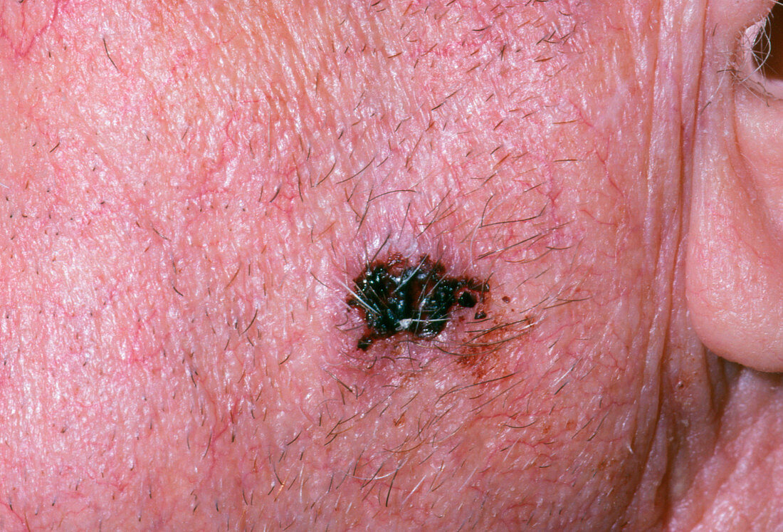 Close-up showing a basal cell carcinoma on face