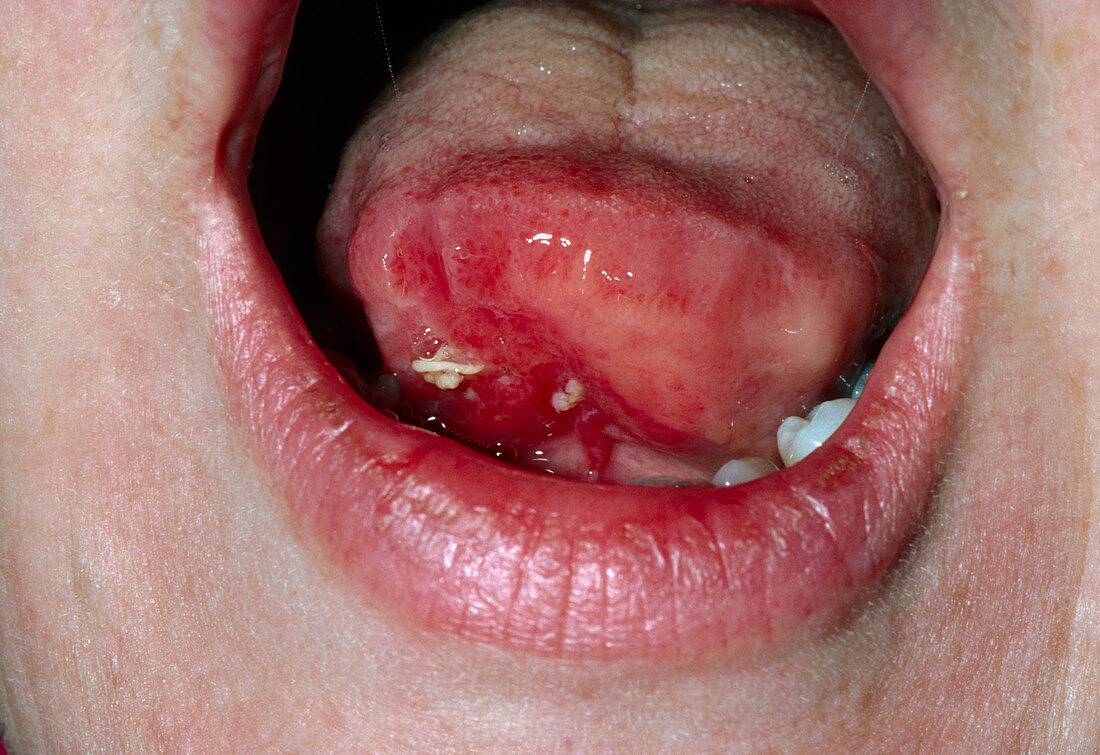 View of squamous cell carcinoma of the tongue
