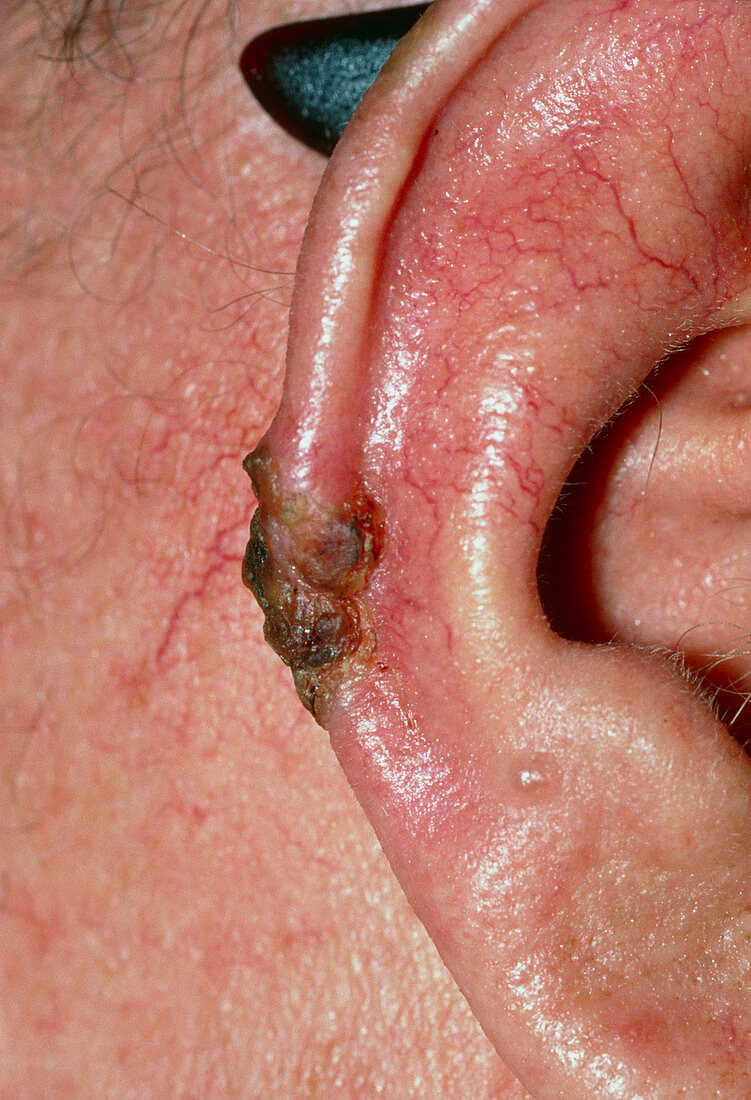 Basal cell carcinoma on skin of ear