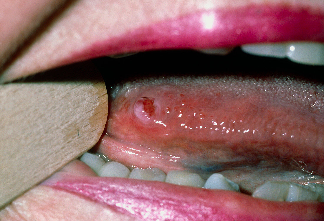 Malignant leiomyosarcoma tumour on woman's tongue