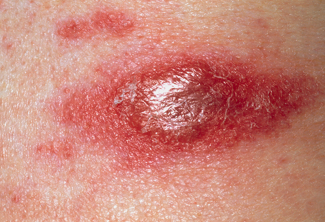 Cancerous red skin lesion due to T-cell lymphoma