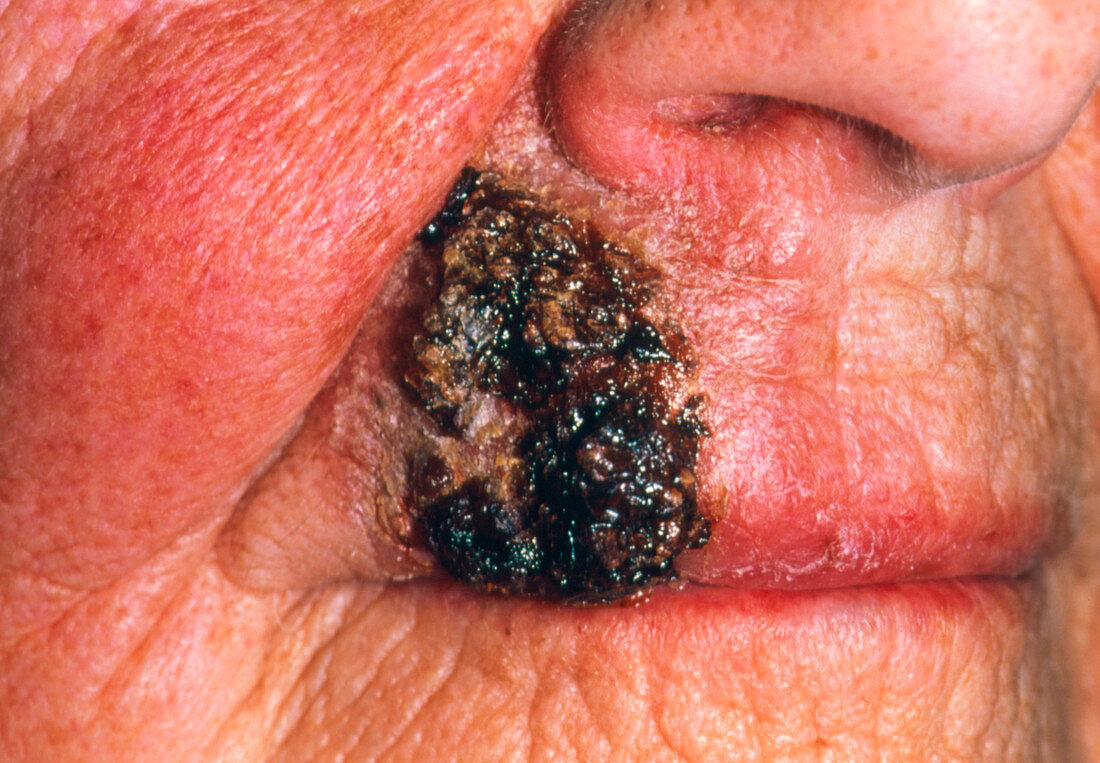 Squamous cell carcinoma on lip after radiotherapy