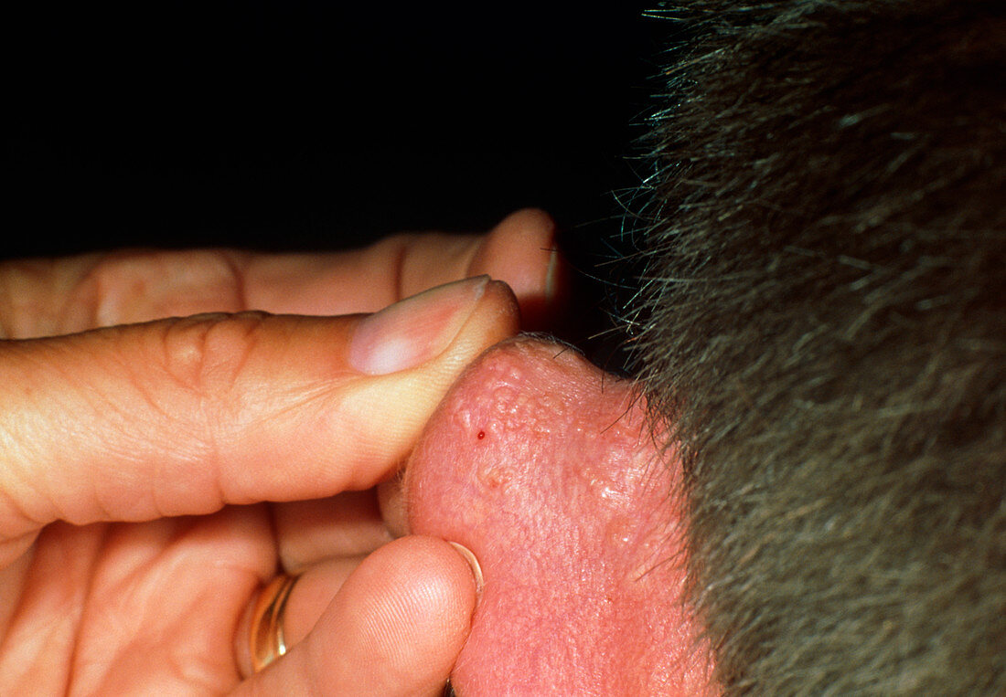 Syringoma papules on a patient's ear