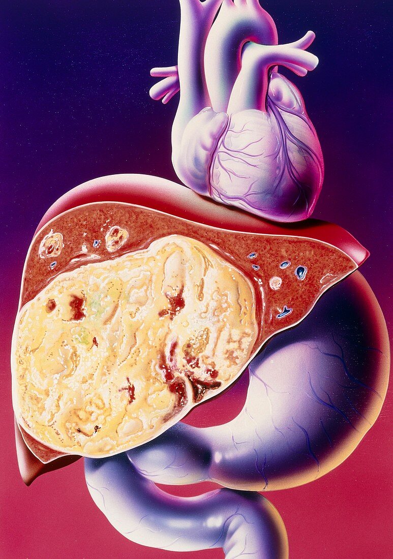 Illustration of carcinoma of the liver