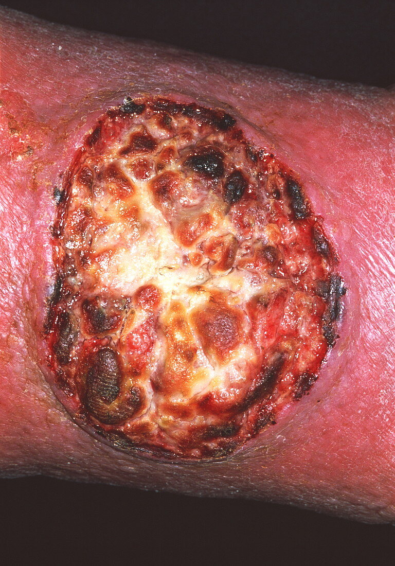 Skin cancer