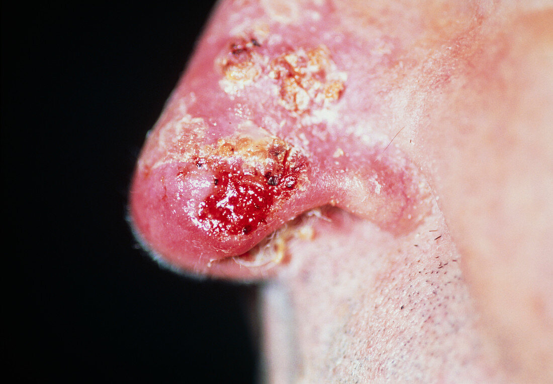 Skin cancer on nose