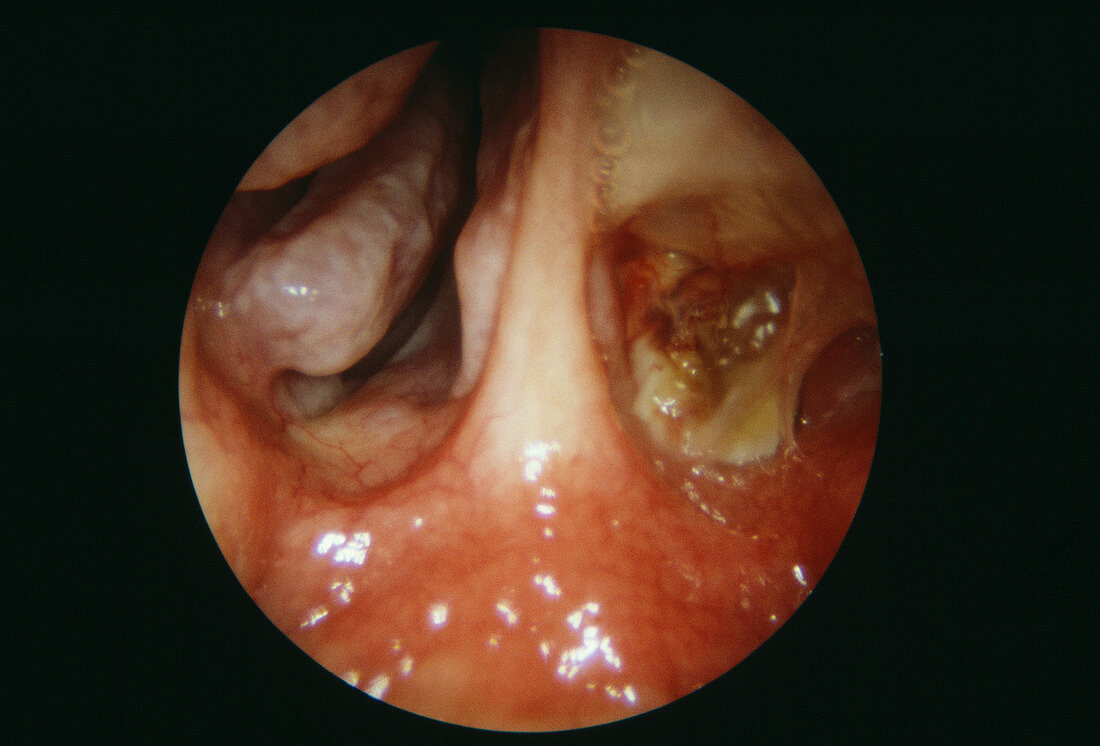 Sinus cancer after treatment