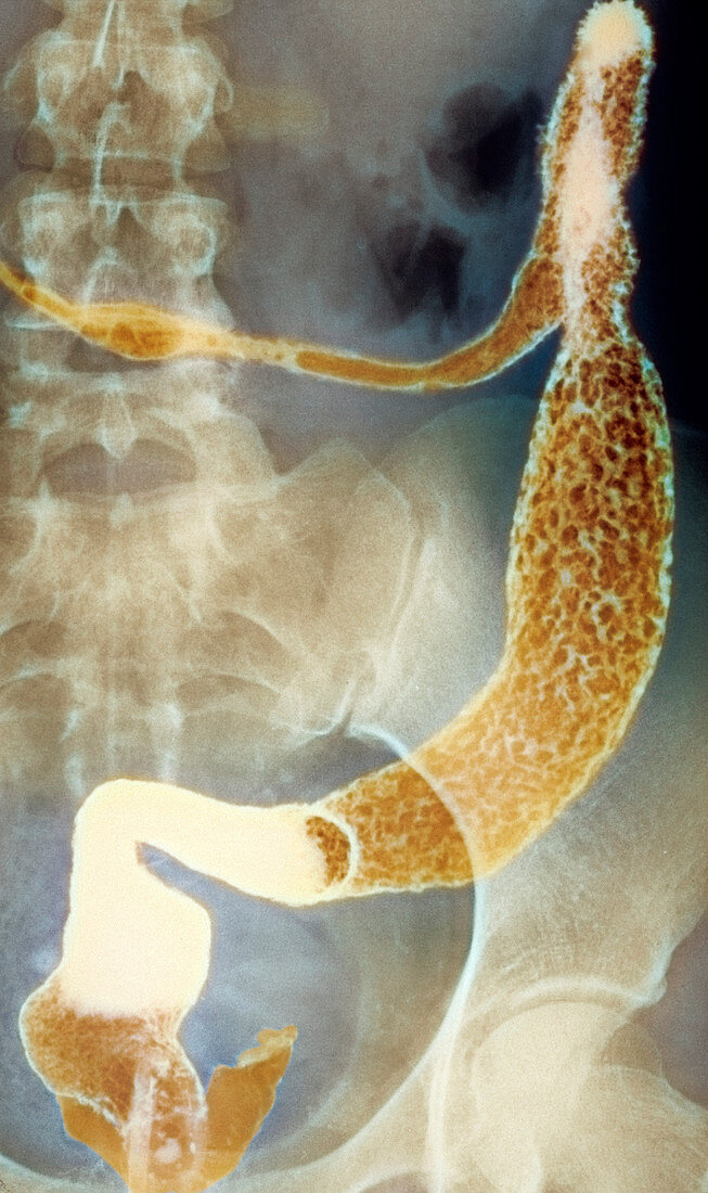 Inflamed colon and rectum,X-ray