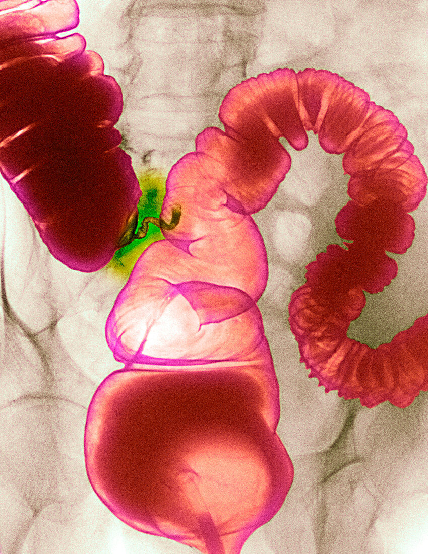 Colonic spasm,X-ray