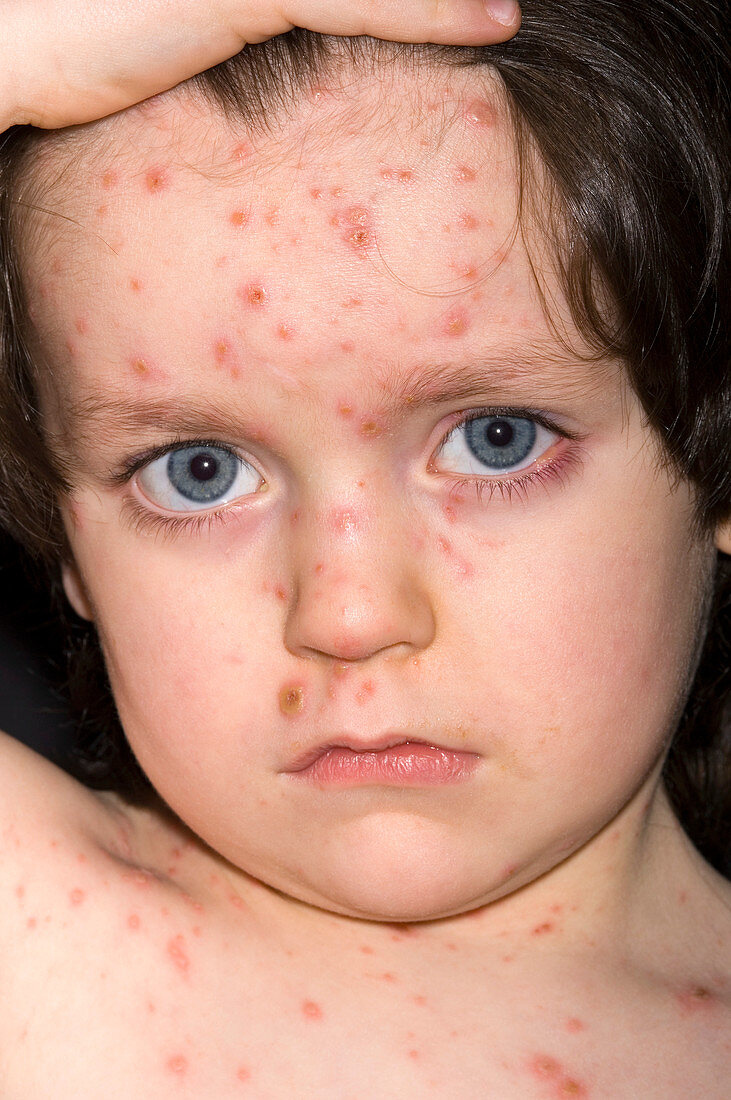 Chicken pox lesions on face