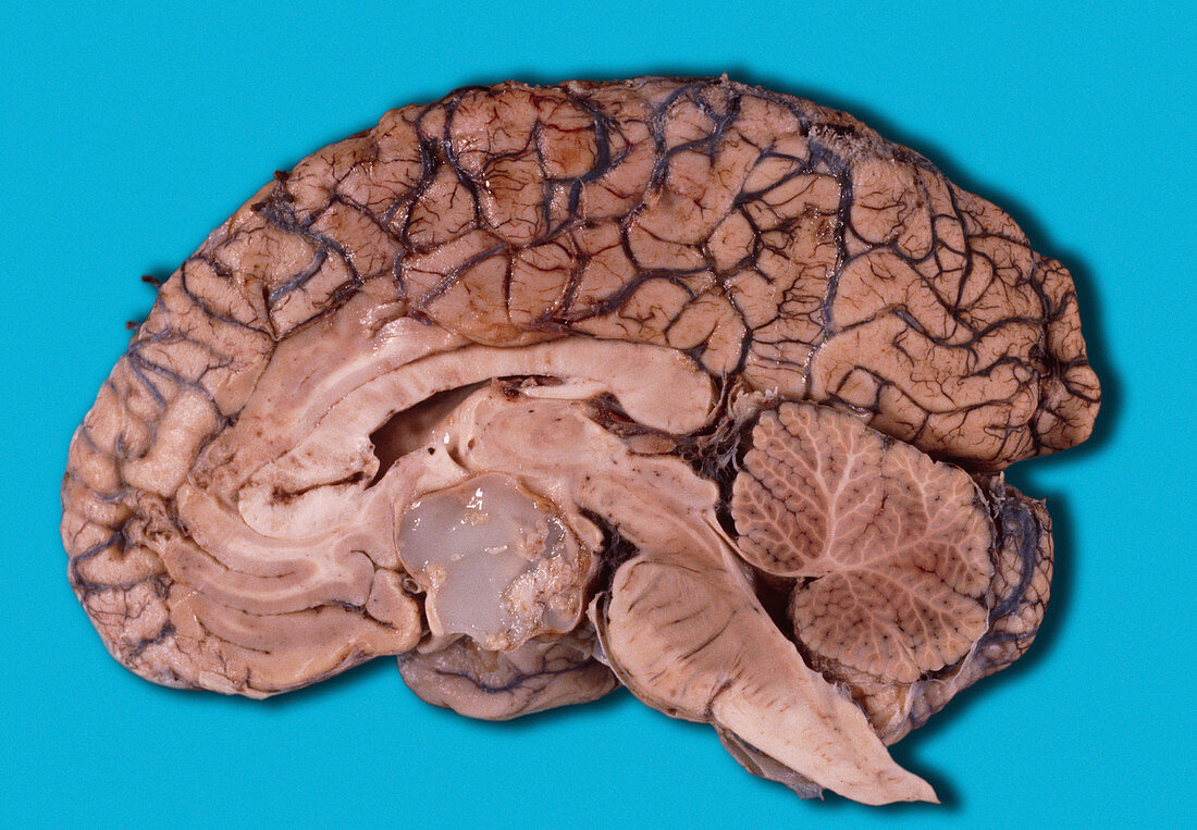 Dermoid cyst in the brain