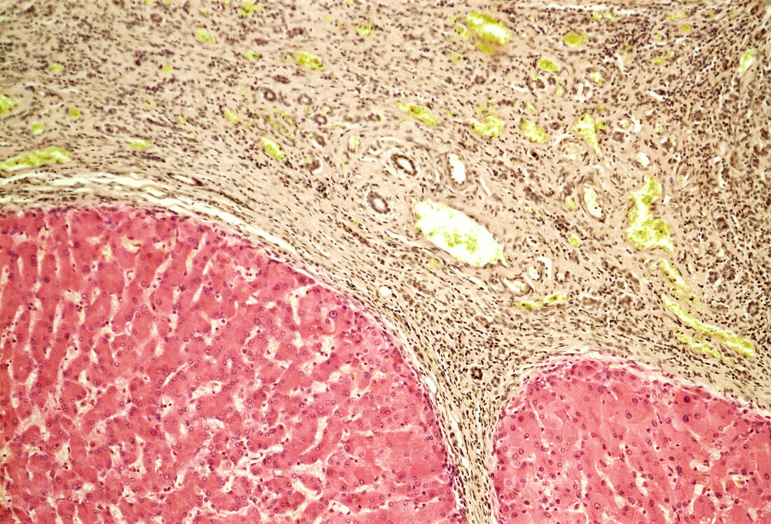 Liver tissue cirrhosis,light micrograph