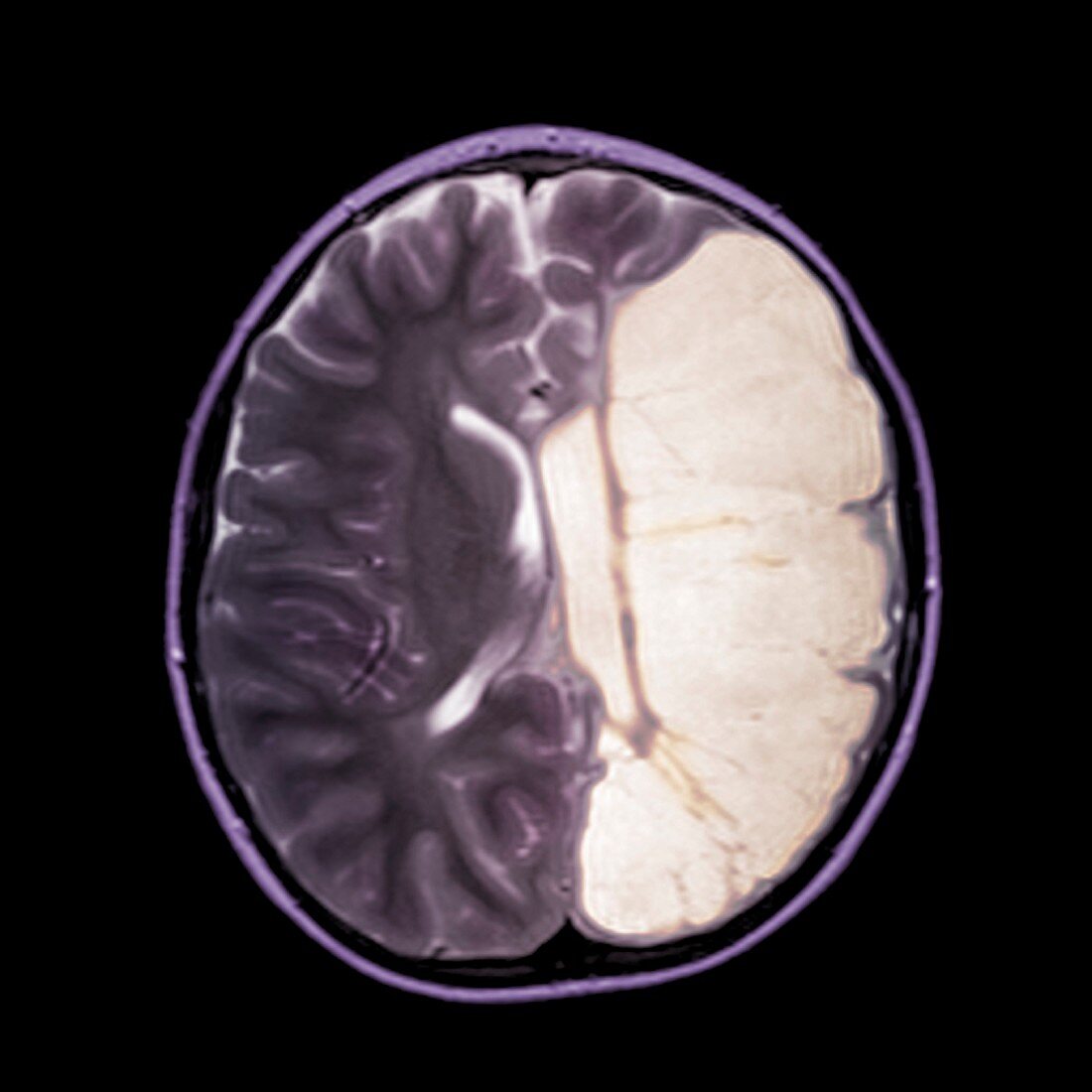 Cerebral palsy,MRI scan