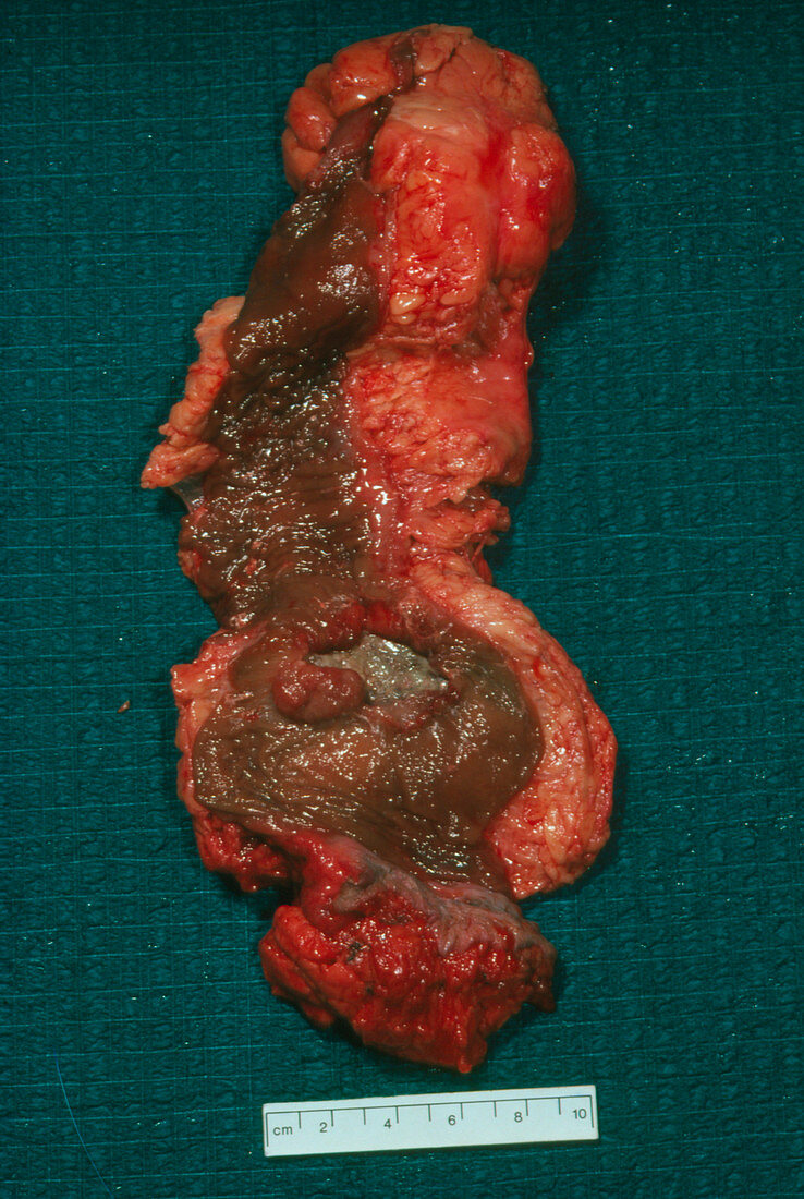 Excised section of cancerous colon/rectum
