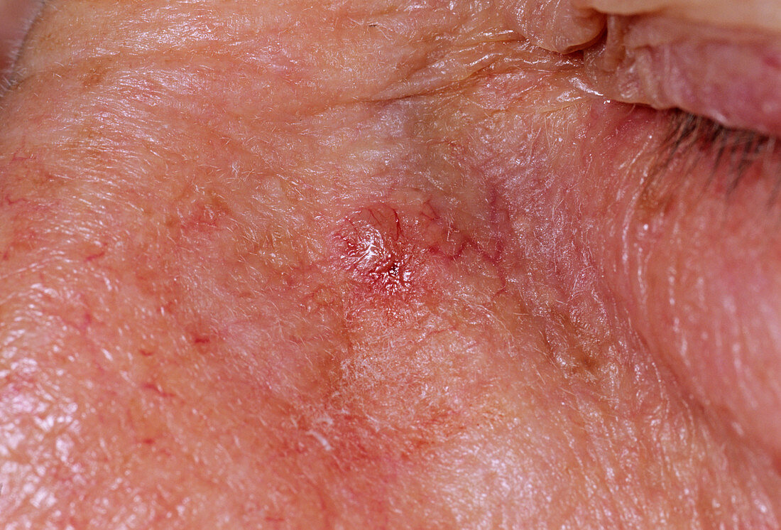 Skin cancer