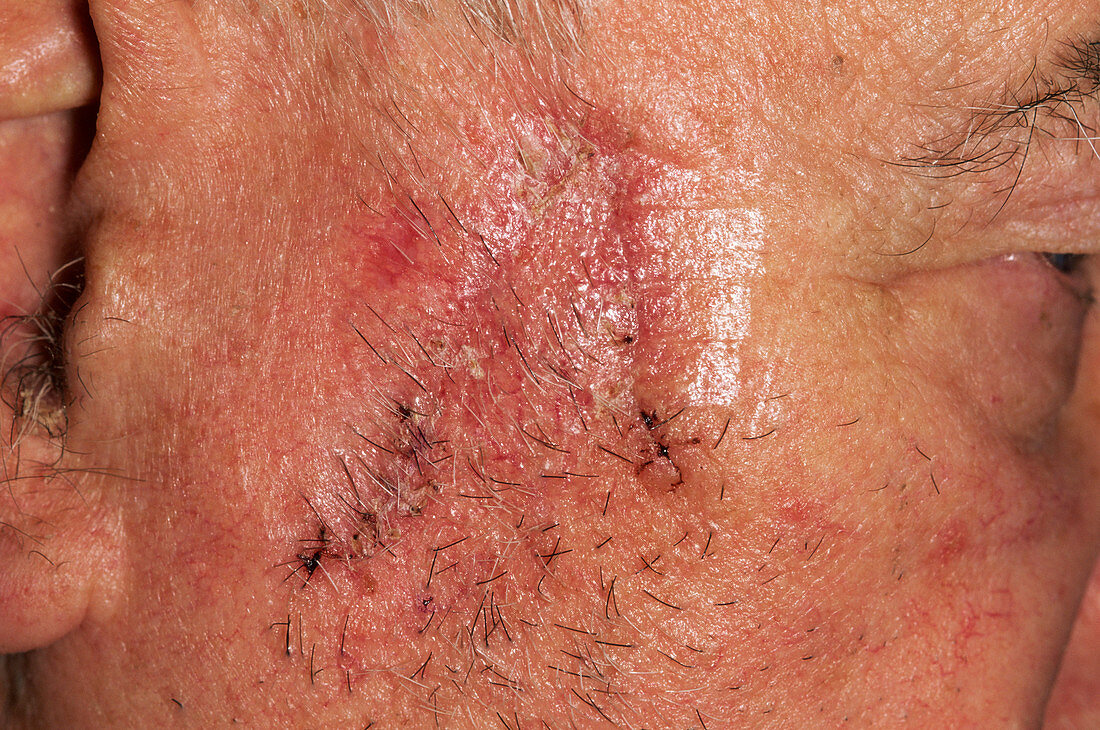 Skin cancer scar