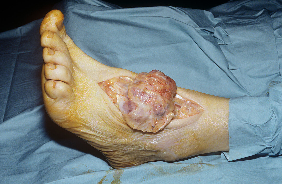 Synovial tumour