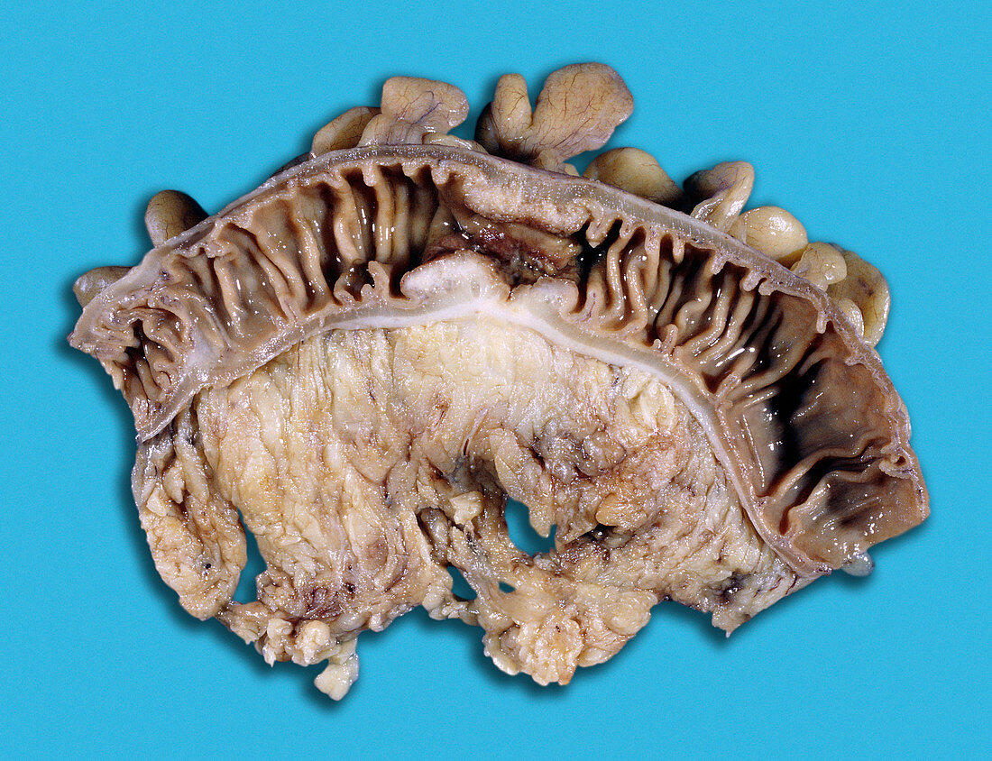 Cancer of the descending colon