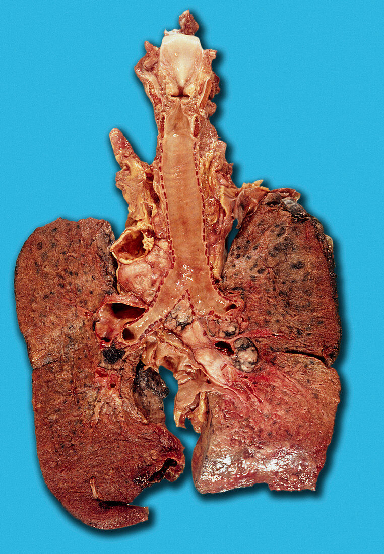 Lung cancer