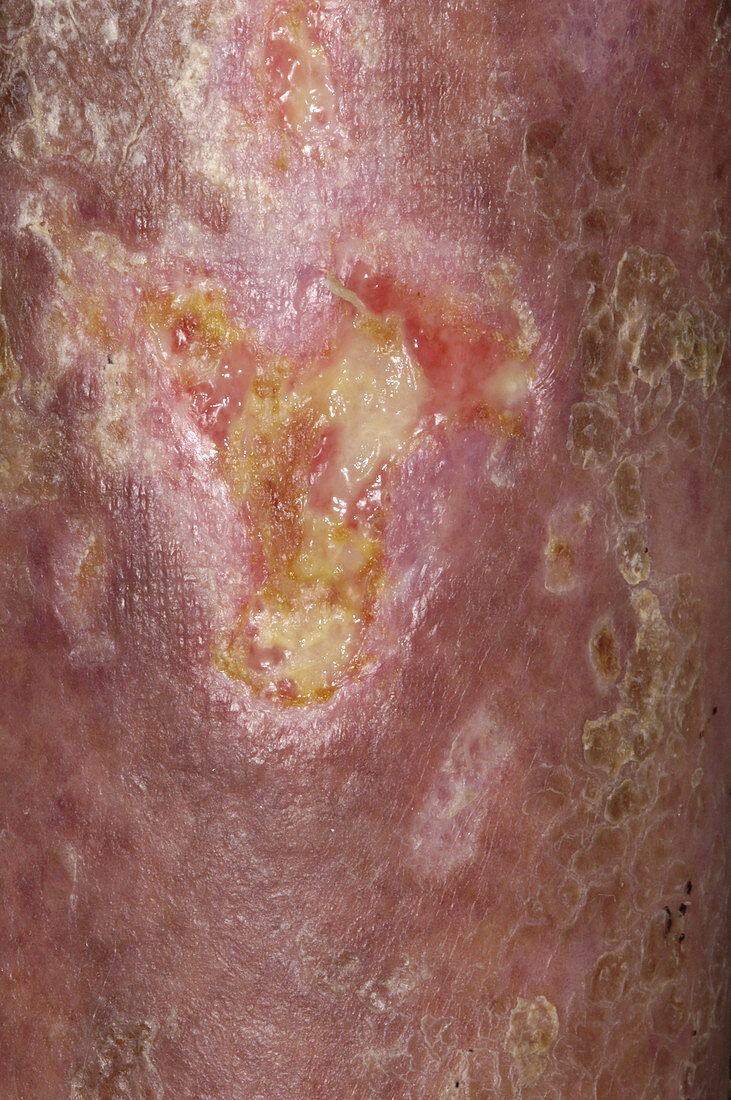 Mycosis fungoides ulcers