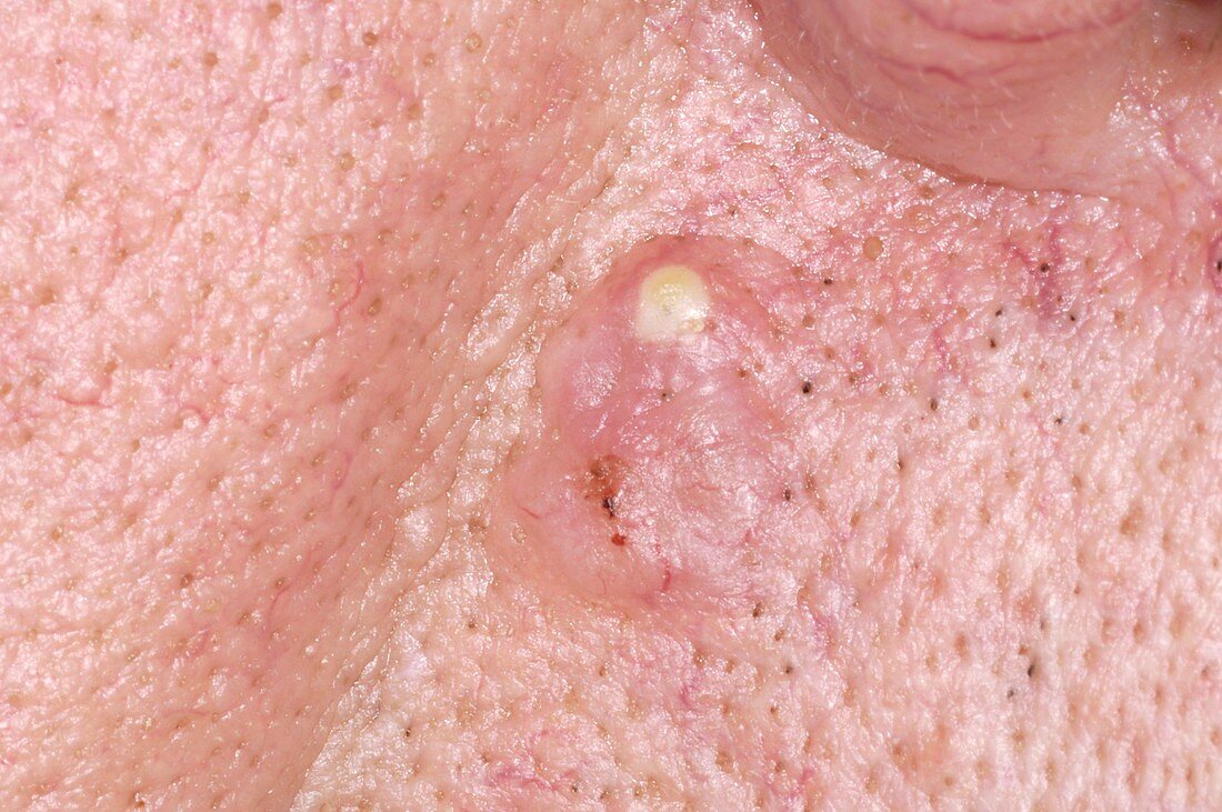 Skin cancer,basal cell carcinoma