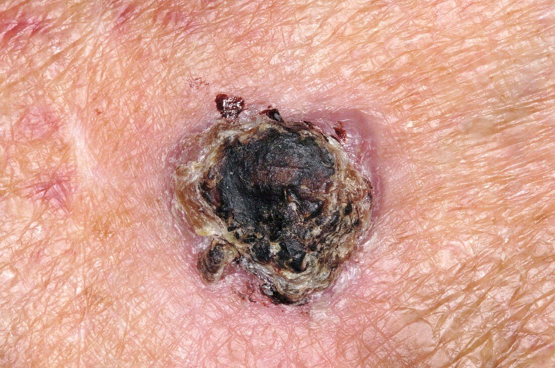 Skin cancer,squamous cell carcinoma