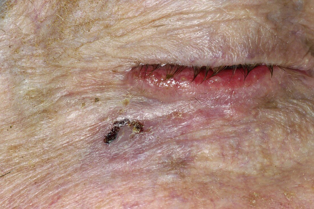 Skin cancer surgery