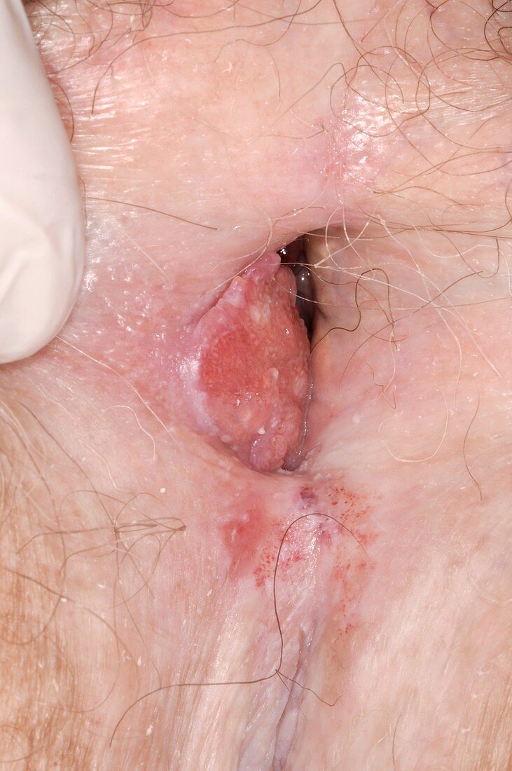 Skin cancer,squamous cell carcinoma