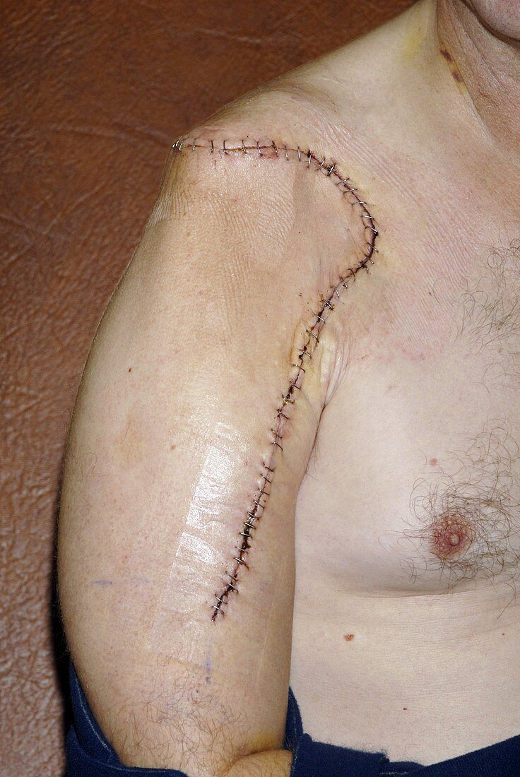 Bone cancer surgery scar