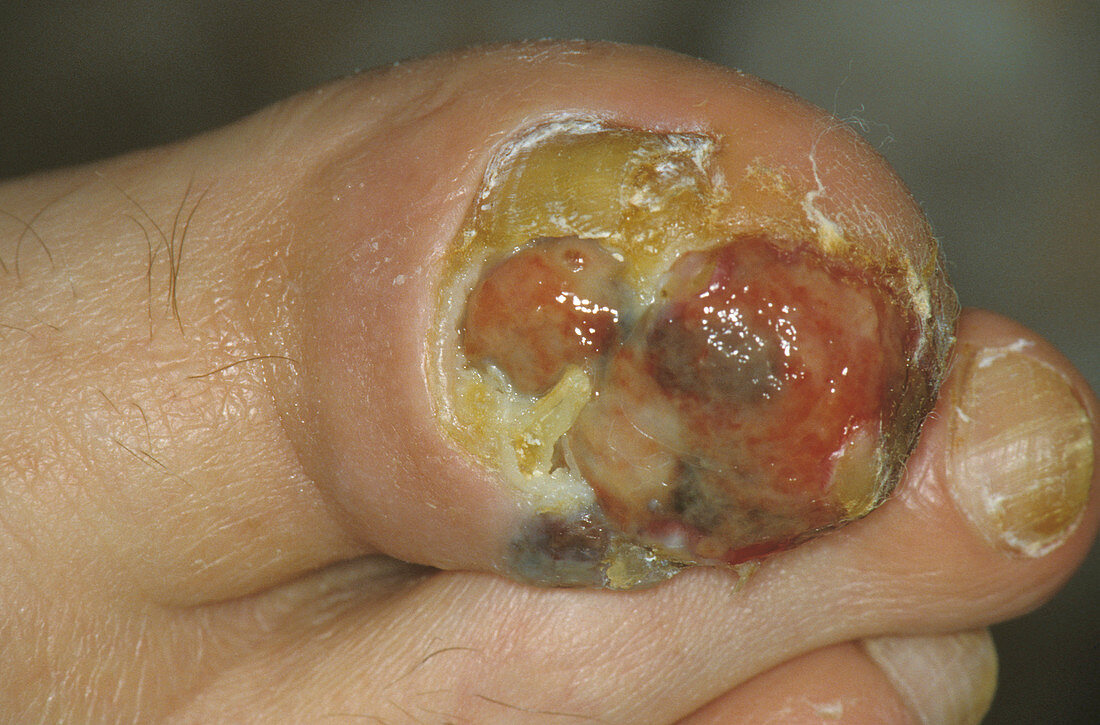 Skin cancer under a toe