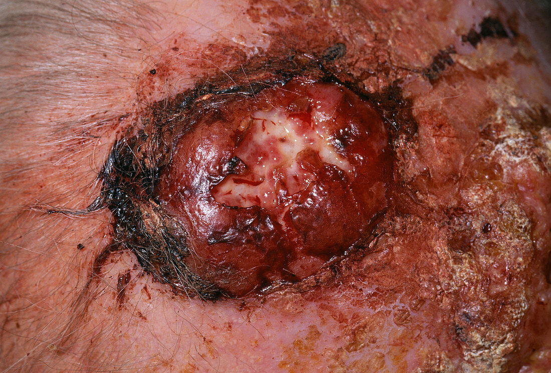 Skin cancer