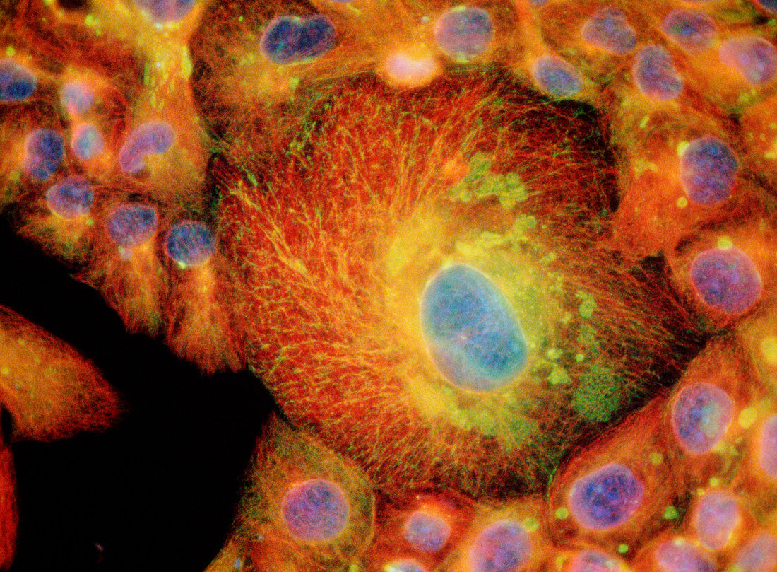 Immunofluores. LM of drug-resistant cancer cells