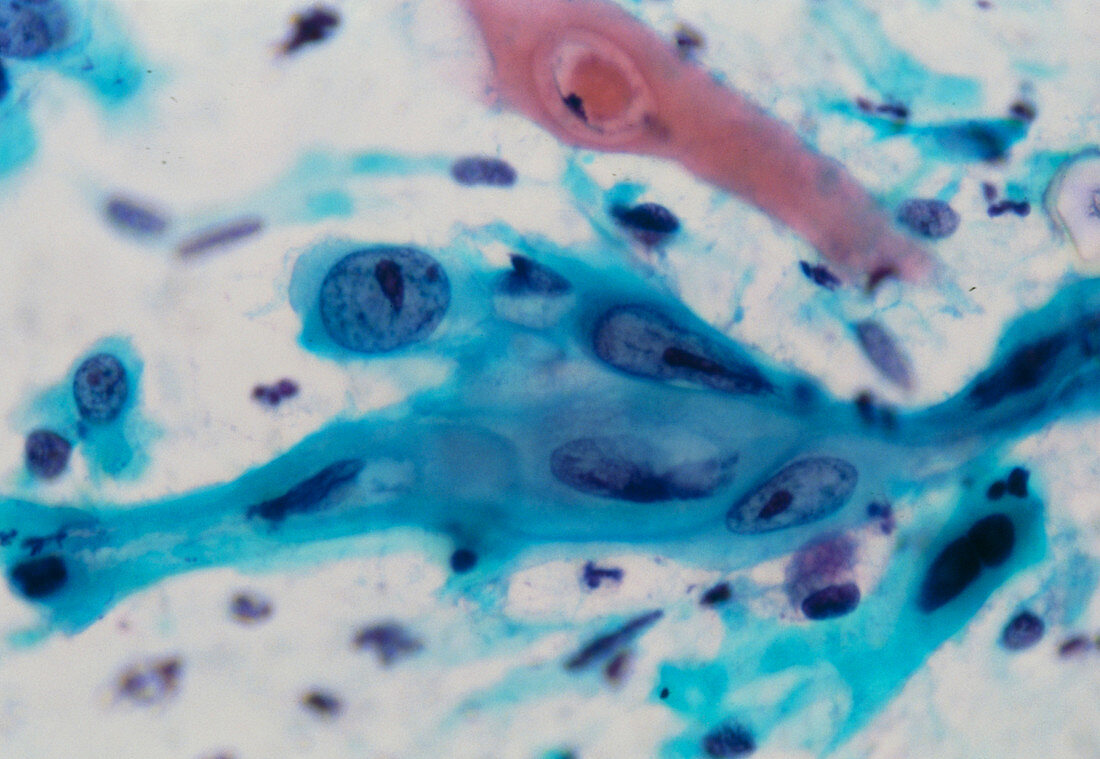 LM of malignant squamous cells from human lung