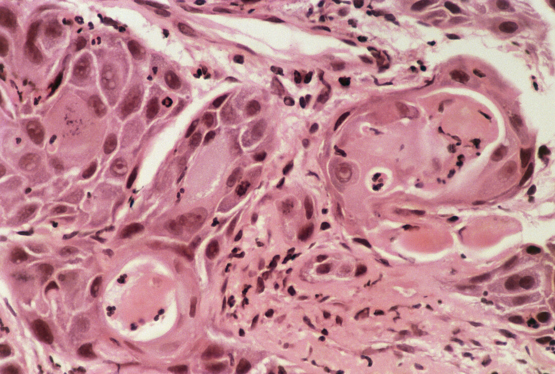 LM of malignant squamous cells from a human lung