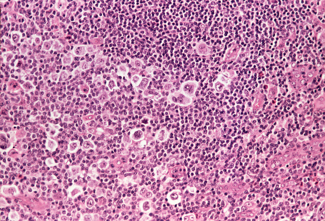 Coloured LM of Hodgkin's disease in lymph tissue