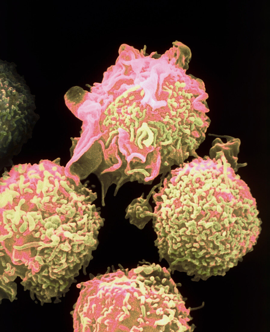 Colour SEM of lymphocytes in hairy cell leukaemia