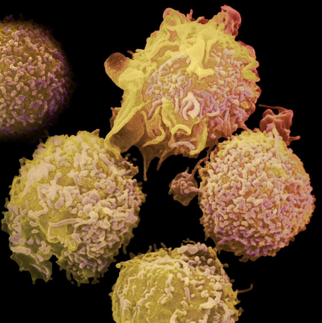 Colour SEM of lymphocytes in hairy cell leukaemia