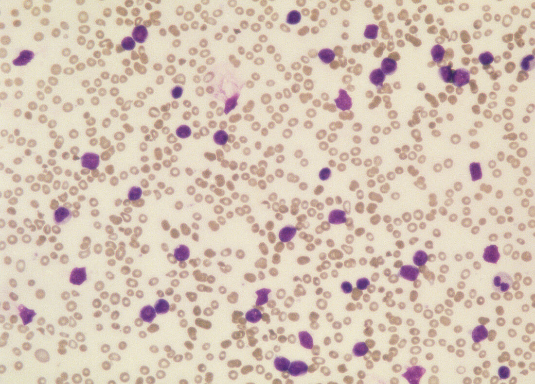 LM of acute lymphocytic leukaemia cells