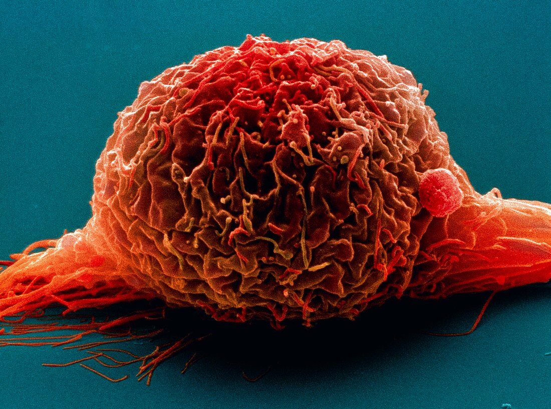 Bladder cancer cell,SEM