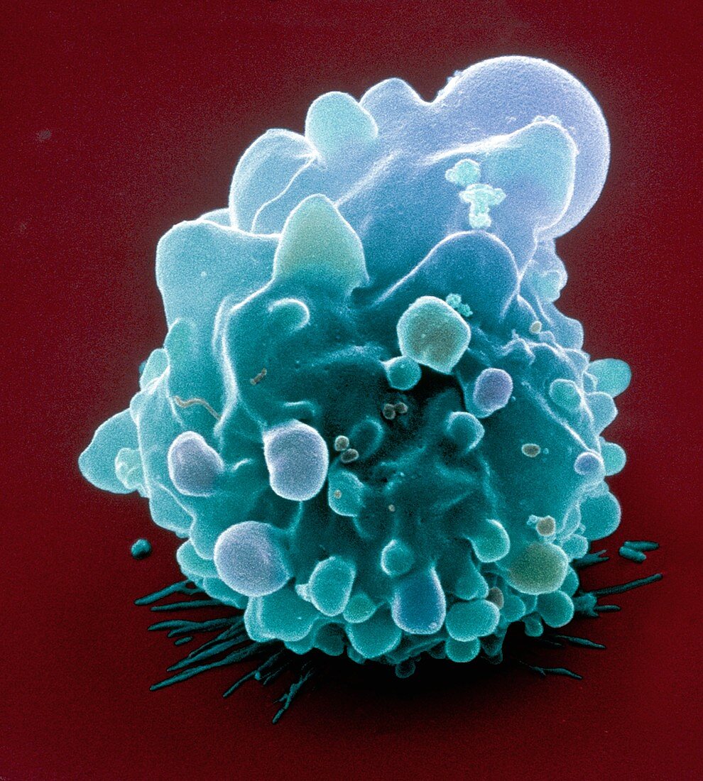Bowel cancer cell,SEM